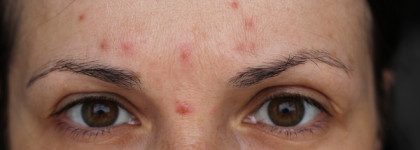 Уход за проблемной кожей средствами от Гельтек