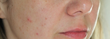 Почему Мадонна выбирает астаксантин? Почему я выбираю Graymelin Astaxanthin stemcell toner