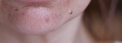 Классная парочка от Openface для реабилитации кожи после пилинга Джесснера