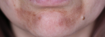 Классная парочка от Openface для реабилитации кожи после пилинга Джесснера