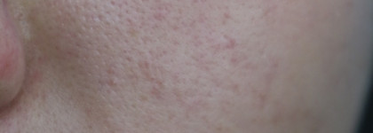Don’t touch my skin…with rosacea! Don’t touch my azacid