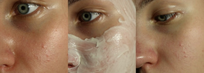 Маска для лица Aravia Post-Acne Balance Mask рассасывающая с поросуживающим эффектом