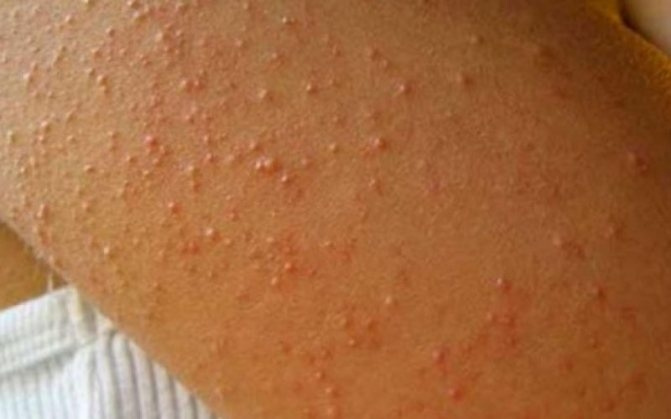 Фолликулярный кератоз: причины, симптомы и лечение «гусиной кожи» | Eucerin