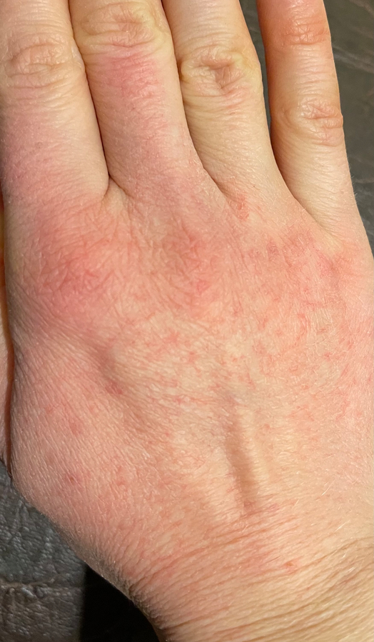 Облазит кожа на пальцах рук: причины шелушения и методы лечения - Fitomarket