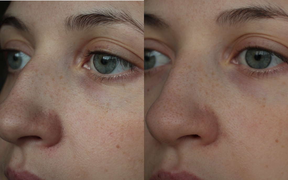 Слева фото ДО использования сыворотки и маски, справа – ПОСЛЕ двух недель тестирования