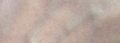 Пилинг Icon Skin 18% Anti-Acne Smart Peel System