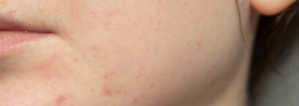 Мягкий пилинг для лица с миндальной кислотой от бренда Uvinion