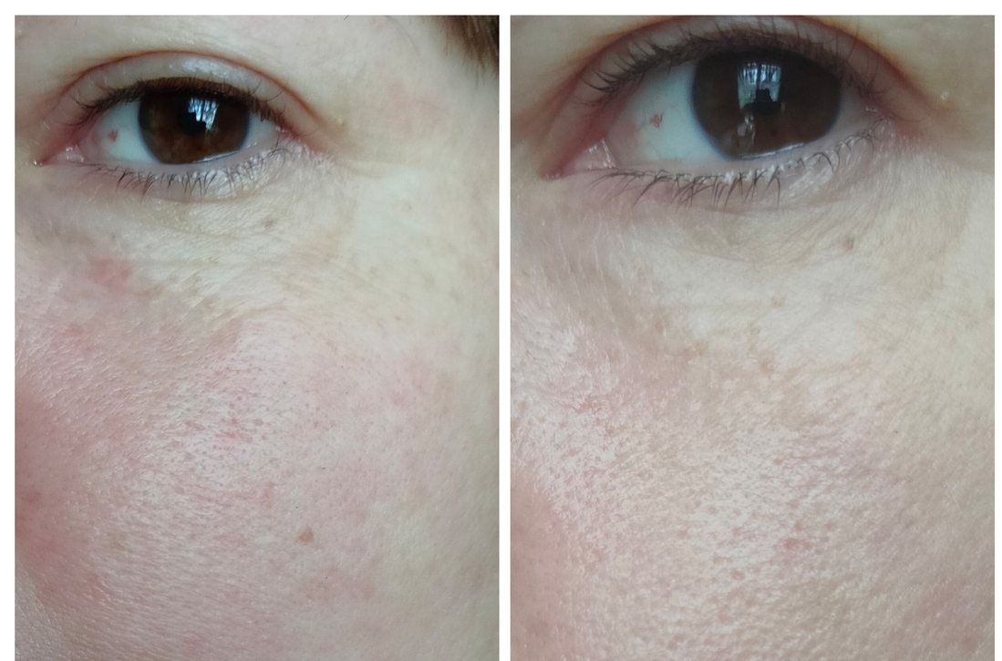 До начала использования крема и после.