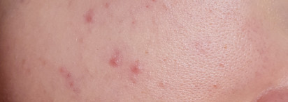 Пилинг для проблемной кожи Icon Skin 18% Anti-Acne Smart Peel System в действии против акне
