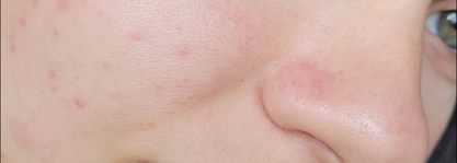 Пилинг для проблемной кожи Icon Skin 18% Anti-Acne Smart Peel System в действии против акне