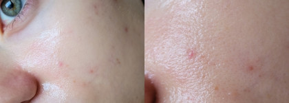 Пилинг для проблемной кожи Icon Skin 18% Anti-Acne Smart Peel System в действии против акне