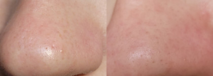 Пилинг для проблемной кожи Icon Skin 18% Anti-Acne Smart Peel System в действии против акне
