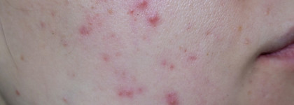 Пилинг для проблемной кожи Icon Skin 18% Anti-Acne Smart Peel System в действии против акне