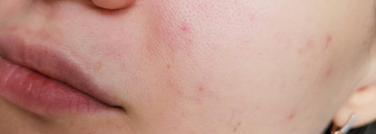 Пилинг для проблемной кожи Icon Skin 18% Anti-Acne Smart Peel System в действии против акне