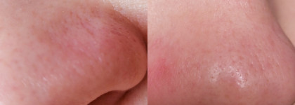 Чистые поры с Энзимной Пектиновой Маской от Гельтек