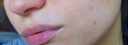 Всесезонный пилинг для лица миндальной кислотой 45% от Uvinion