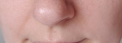 Плюс увлажнение, минус акне: SVR Sebiaclear Hydra Anti-Marks Soothing Repairing Moisturizer