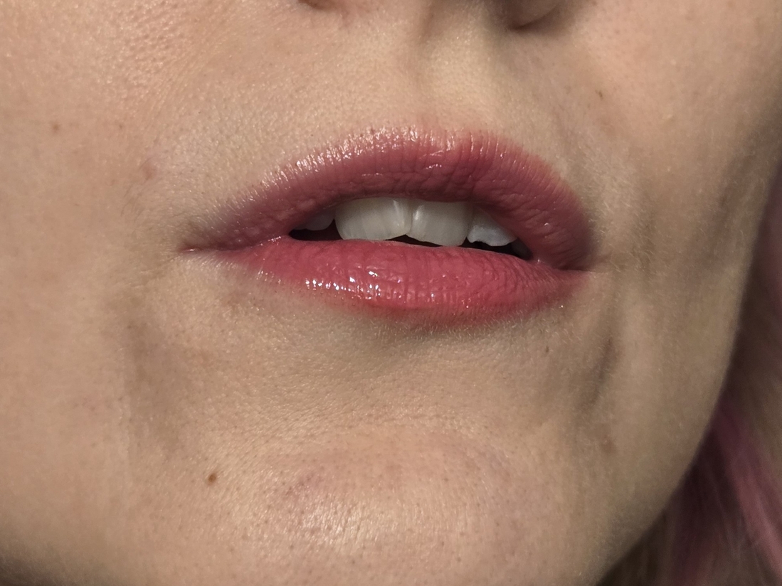 насколько лучше стали смотреться губы!