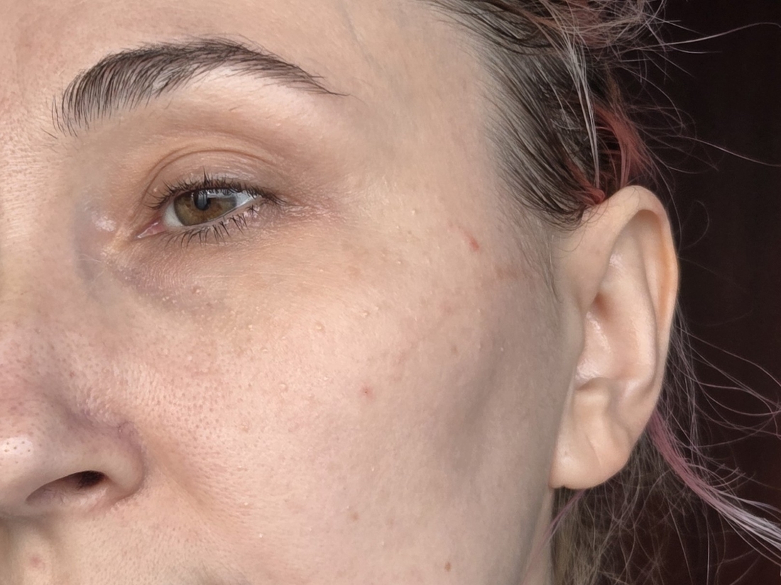 Сухая кожа после умывания при дневном свете