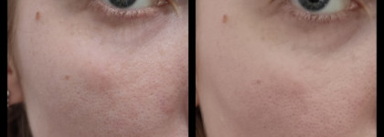 Если помощь нужна быстро: La Roche-Posay Effaclar duo(+) corrective unclogging care anti - imperfections