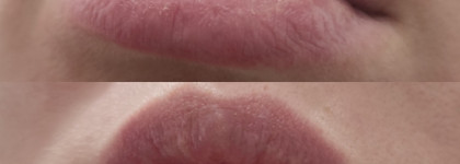 Гигиеническая помада для очень сухой кожи губ Гиалурон EVO Laboratories