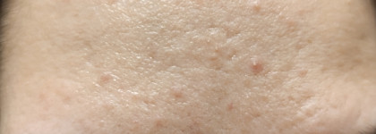 С открытым лицом. Три средства от Openface для проблемной кожи