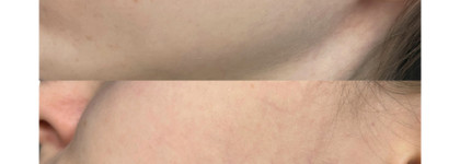 Избавляемся от пигментации вместе с сывороткой Eucerin Anti-Pigment Dual Serum. Фото до/после
