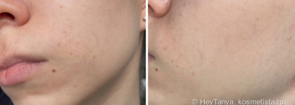Избавляемся от пигментации вместе с сывороткой Eucerin Anti-Pigment Dual Serum. Фото до/после