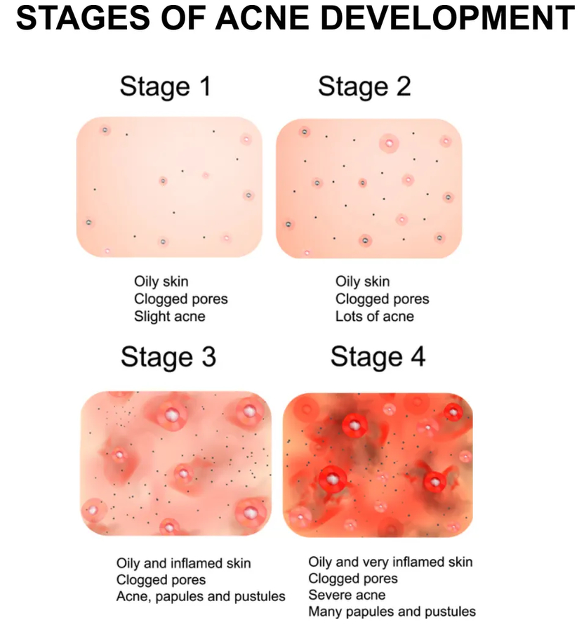 Источник rejuviss.com/derma-roller-size-for-deep-acne-scars/