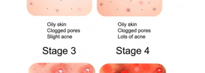 Уход мужчины с акне: наш опыт, советы и прекрасный результат