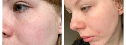 Что изменилось в моем уходе за чувствительной кожей за этот год