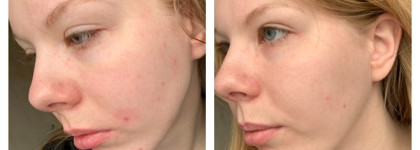 Что изменилось в моем уходе за чувствительной кожей за этот год