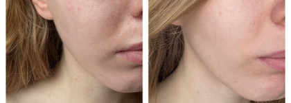 Reviderm peptide line lift mask - как я борюсь с отеками, до и после