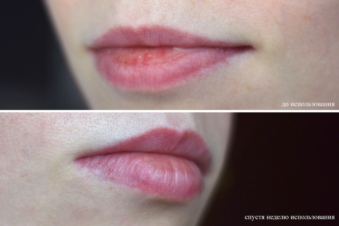Голые губы до ипользования Rhode Peptide Lip Treatment и через неделю после постоянного использования
