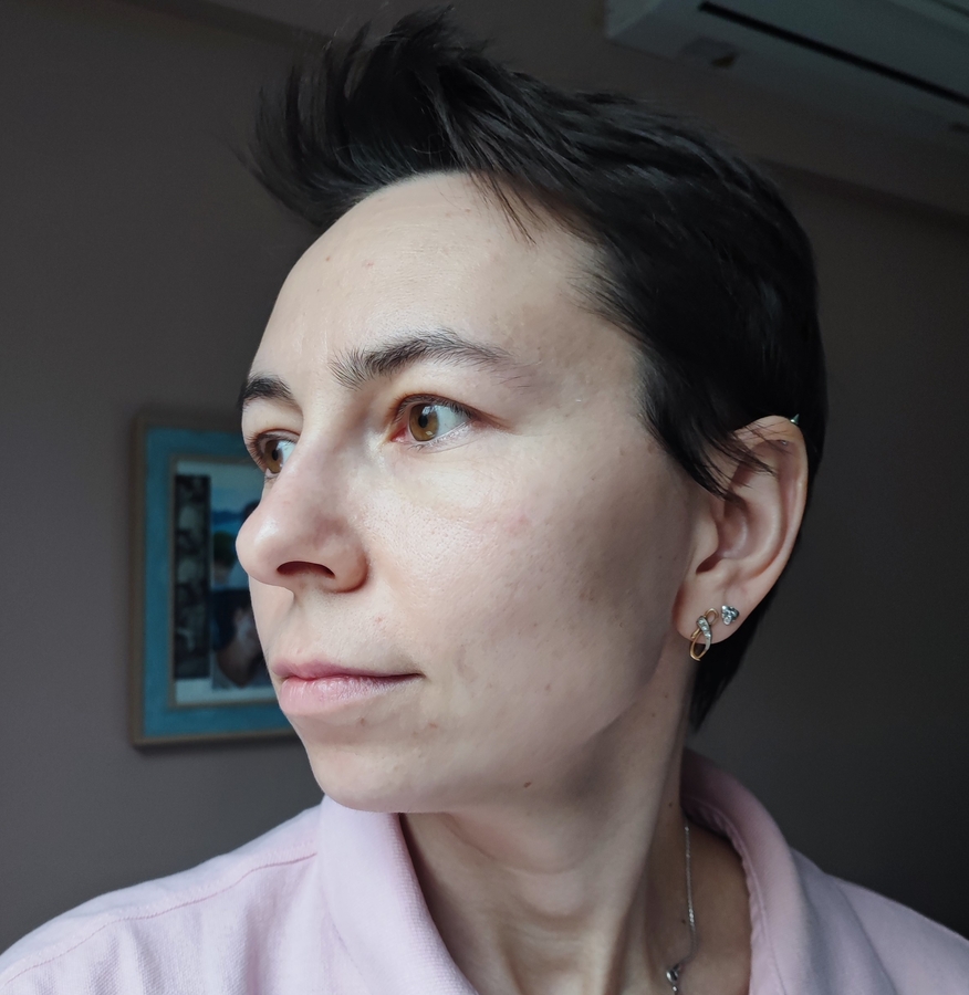 Веко осталось со мной, но носогубка стала более ровной