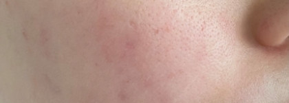 Неоднозначное приобретение: SVR Sebiclear Hydra Anti-Mark Soothing Repairing Moisturizer - увлажнение не самой проблемной кожи