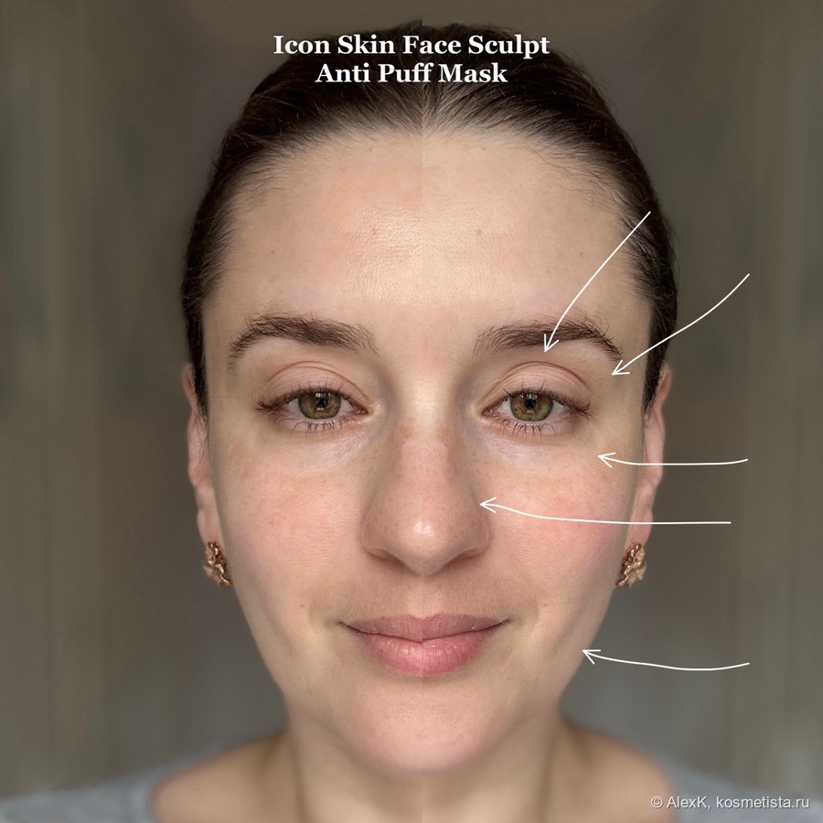 Слева До, справа После. Глаз открылся, отек на носу стал меньше, контур лица подтянулся.