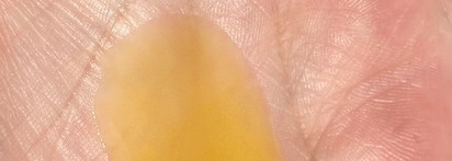 Эффект с первого применения Mirrolla Sulsen Forte Dermatologic шампунь с кетоконазолом против перхоти для всех типов волос