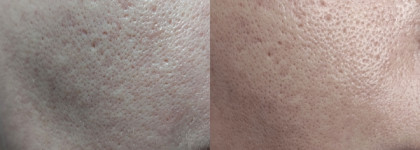 Утюг для кожи: сыворотка с ниацинамидом Booster Bar Immuno Protector Booster