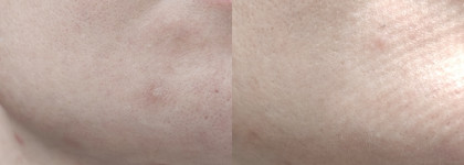 Первый кислотный продукт, который мне подошёл: тонер Booster Bar Renewal Toner