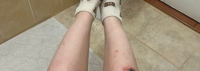 Нейродермит и La Roche-Posay Lipikar Syndet AP+ — мой интересный опыт