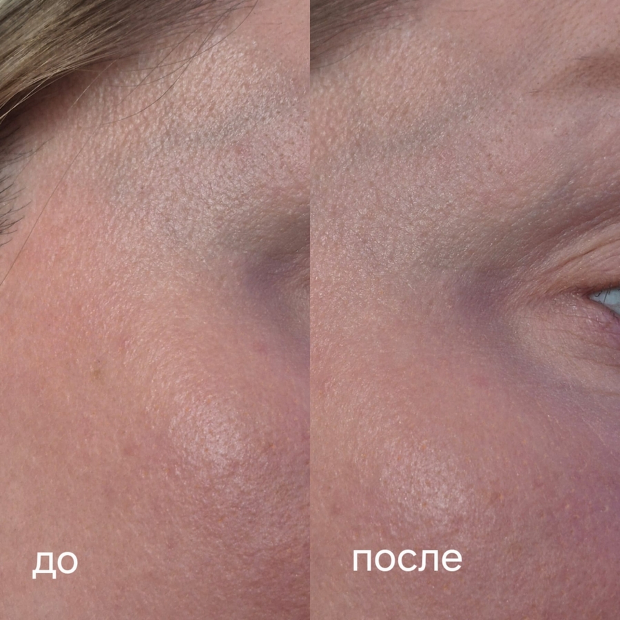 Зона виска и верхней части щеки на макро