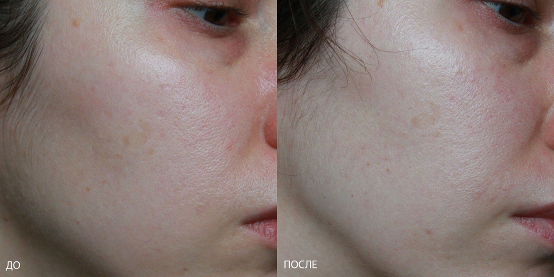 Результаты использования до и после при дневном освещении