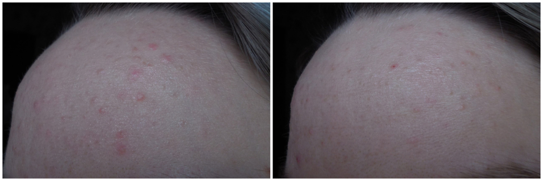 Как было до начала использования крема и спустя несколько недель