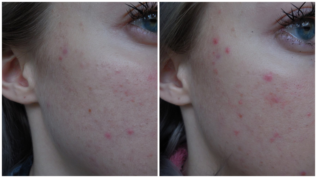 Как было до начала использования крема и спустя несколько недель. Нет, к сожалению, я не перепутала фото