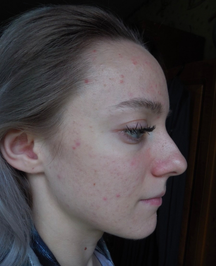 Кожа перед самым началом использования крема