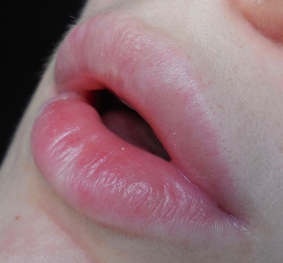 Губы до использования бальзама