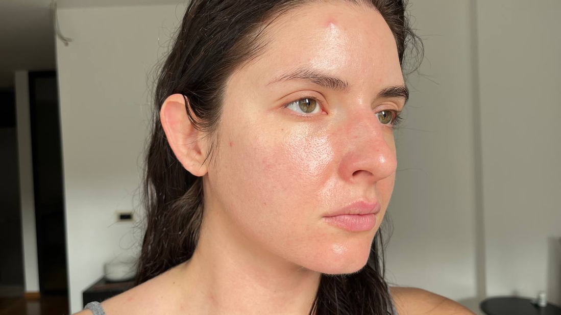 воспаление на лбу, расширенные поры на щеках