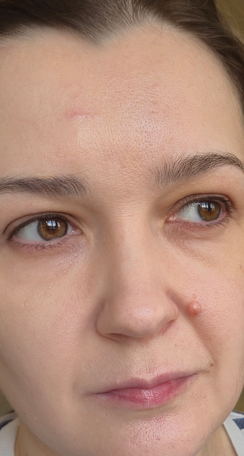 По лбу,если приглядеться,заметны границы нанесения тона. Видно,что поры стали менее заметными, видно общее выравнивание цвета лица в сравнении. Напоминаю, левая половина накрашена, правая нет.