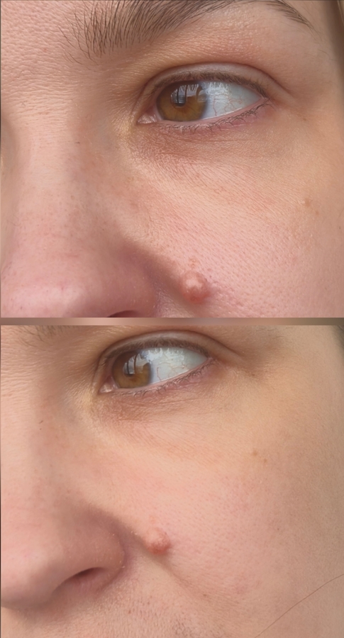 Лицо без макияжа,только уход. Сверху до,снизу после. Подчеркнула шелушения у крыльев носа